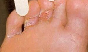 Lesiones de dermaid por la micosis del pie