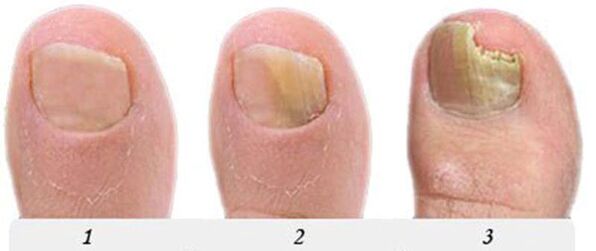 El proceso de desarrollo del hongo del pulgar