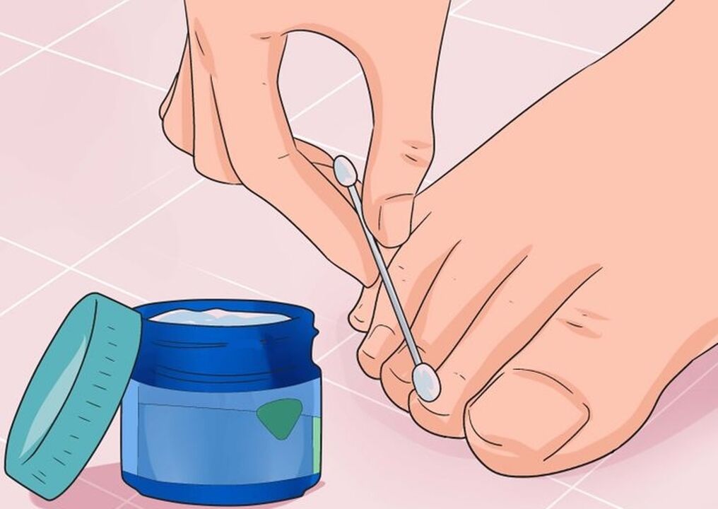 Él cuida el hongo de las uñas