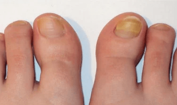 La fase inicial del hongo de las uñas