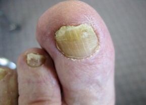 Las causas de la aparición del hongo en las uñas