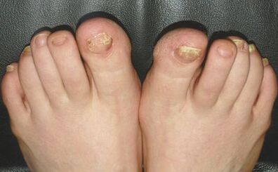 Signos de champiñones en las uñas