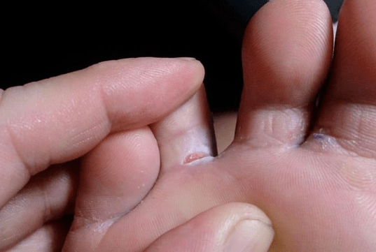 La aparición de formaciones de burbujas en los pies
