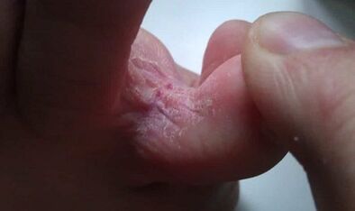 Fase del desarrollo del hongo entre los dedos de los pies
