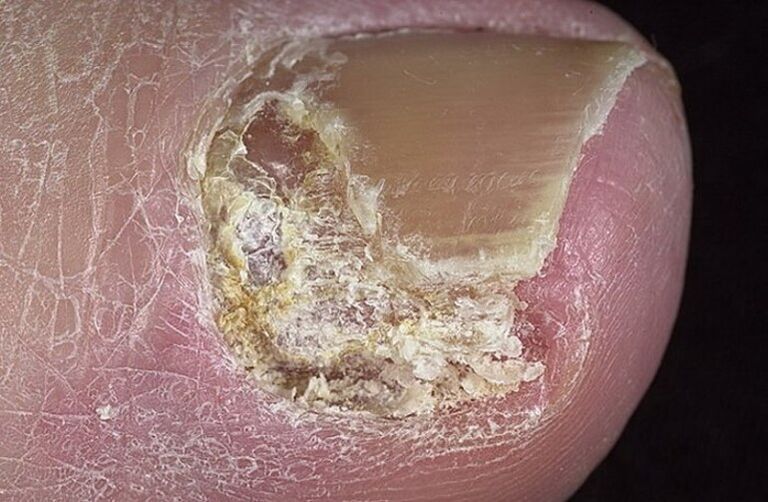 Tipos de onicomicosis
