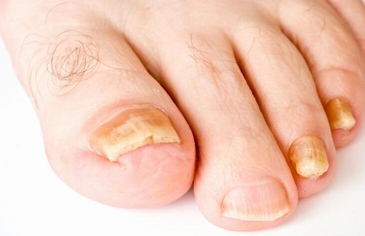 uñas de los pies amarillas debido a hongos