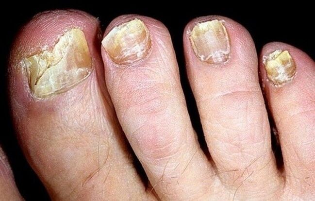 hongos en las uñas de los pies